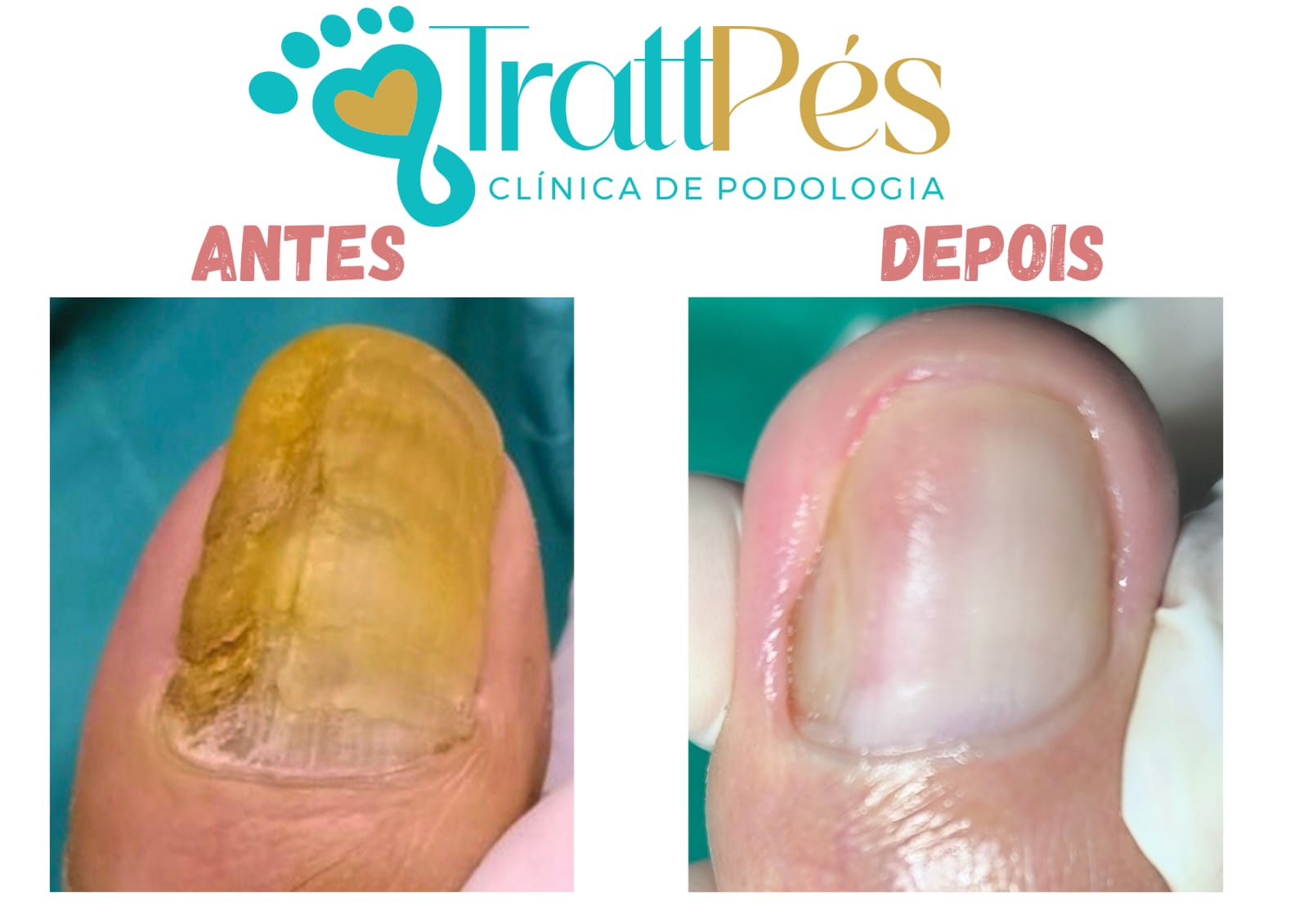 Registro de antes e depois do cuidado das unhas enviado pela TrattPés