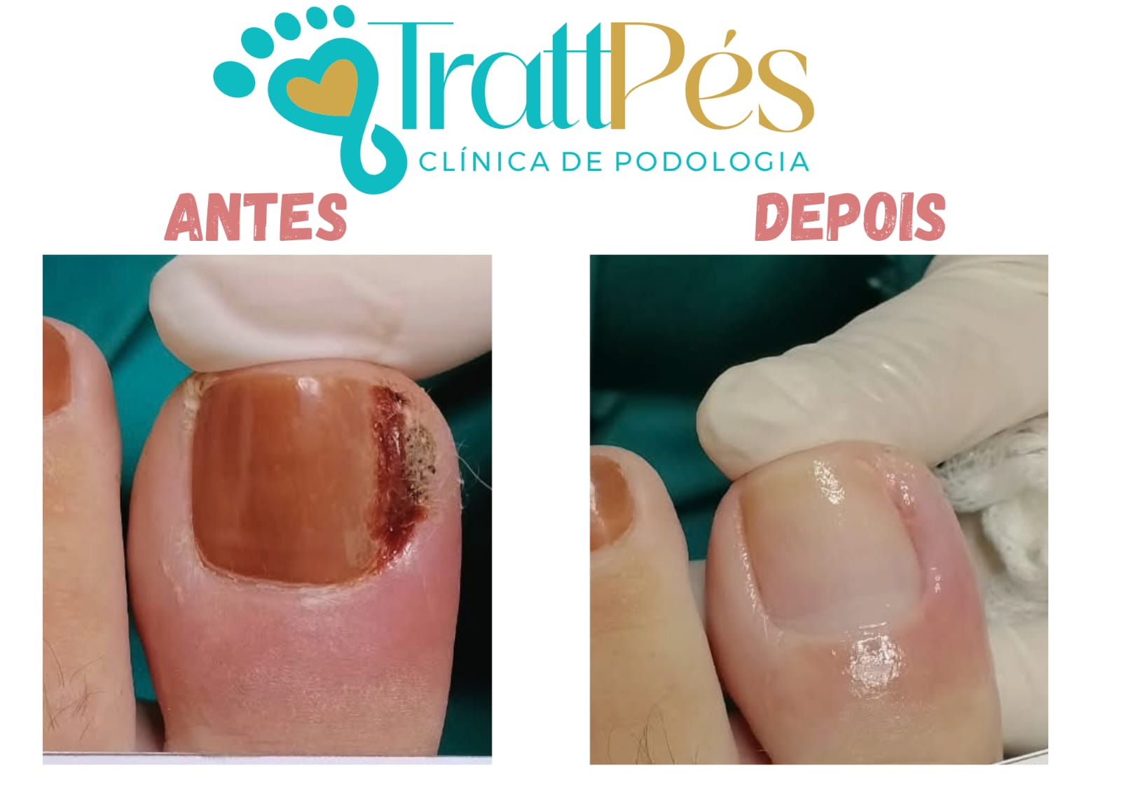 Registro de antes e depois do cuidado de unha encravada enviado pela TrattPés